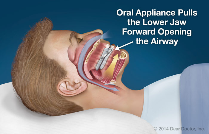 Oral Sleep Appliance 91