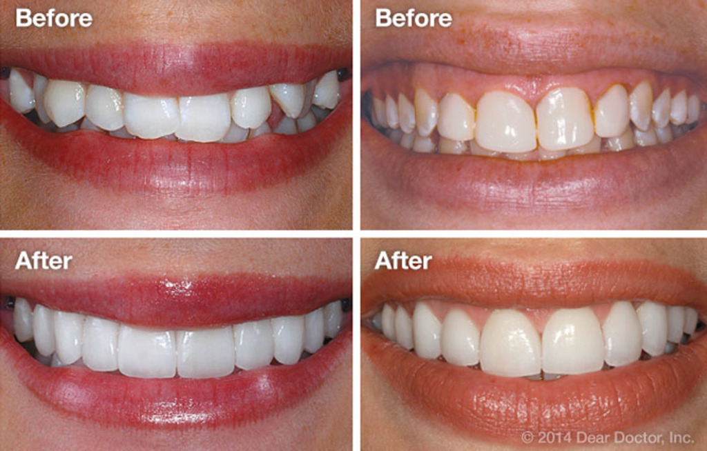 Can Porcelain Veneers Fix Crooked Teeth? DentalPlans Blog