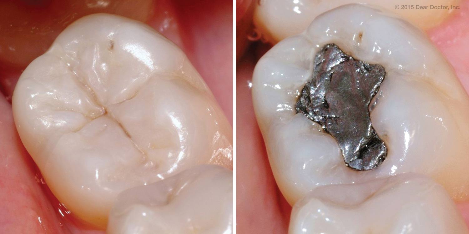 Tooth Colored Fillings vs Metal Which is Better DentalPlans Blog